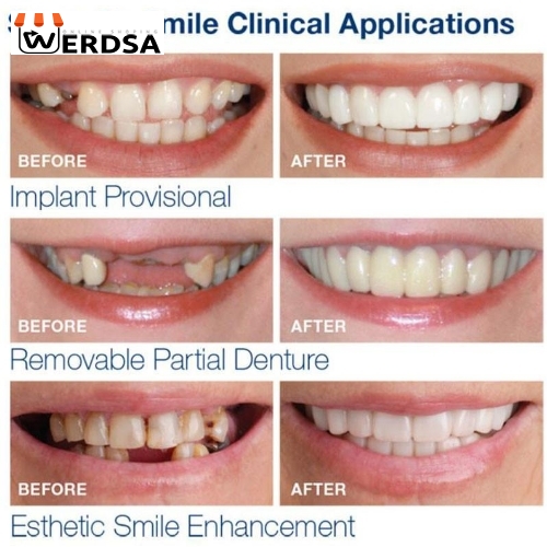 لمینت متحرک دندان دو فک snap on smile کد 1497 شرکتی اصلی